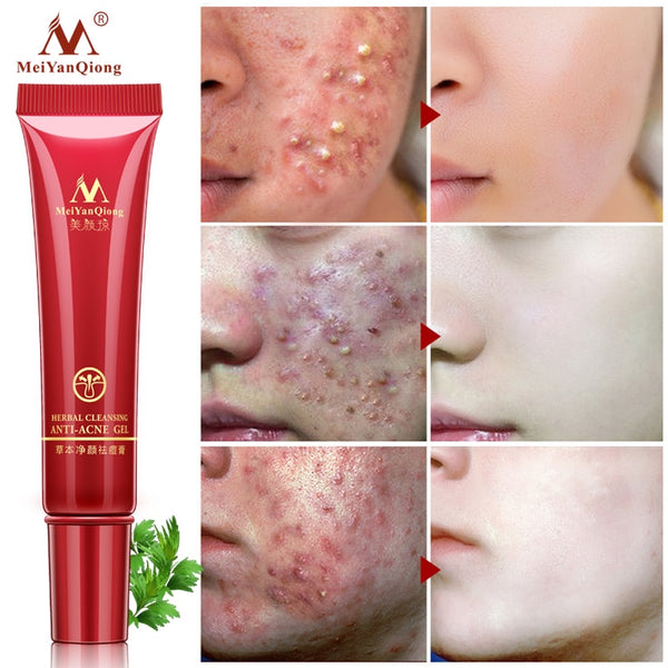 High Quality Herbal Cleansing Face Anti acne treatment
